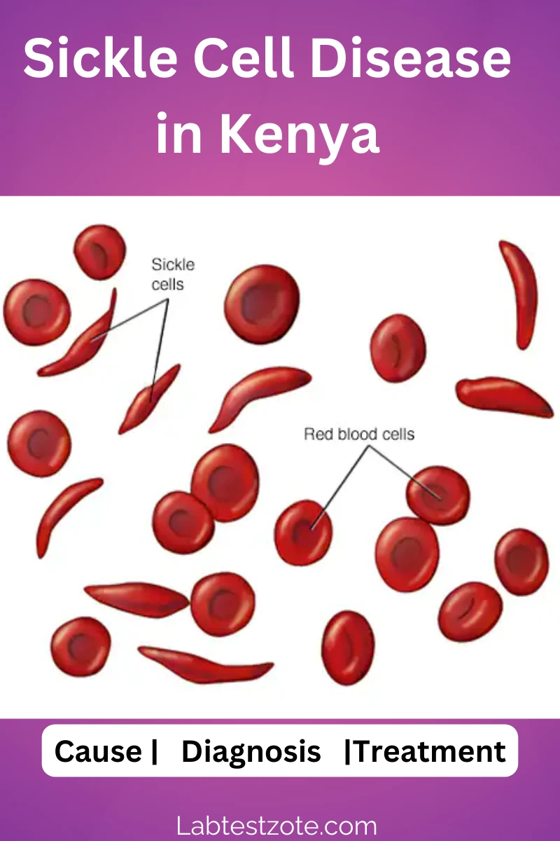 Sickle Cell Disease