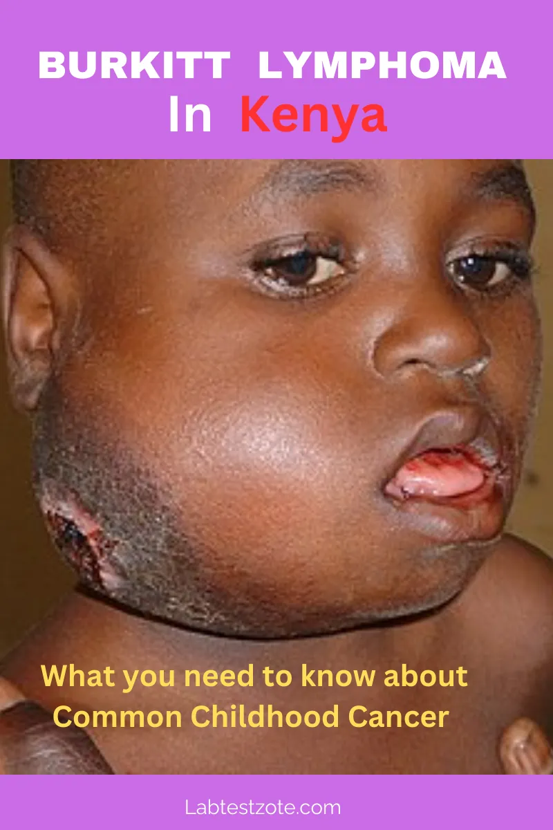 Burkitt Lymphoma in Kenya- Overview An Aggressive Childhood Cancer