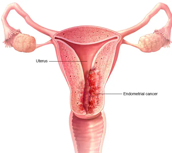 Endometrial cancer