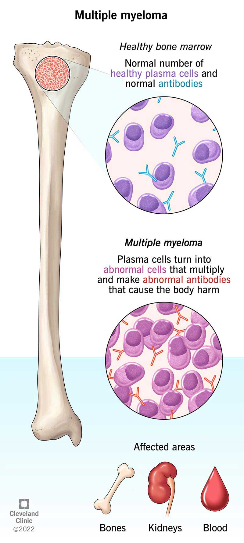 a bone with multiple myeloma cells