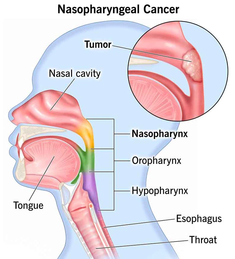 Nasopharyngeal Carcinoma
NPC