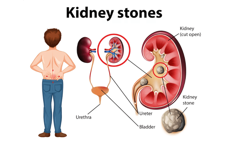 Kidney Stones [Nephrolithiasis] can affect any part of the urinary tract.