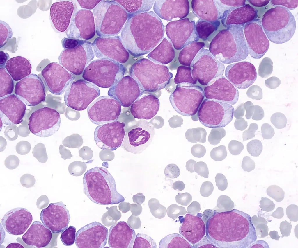 Acute Myeloblastic Leukemia  - Peripheral Blood film