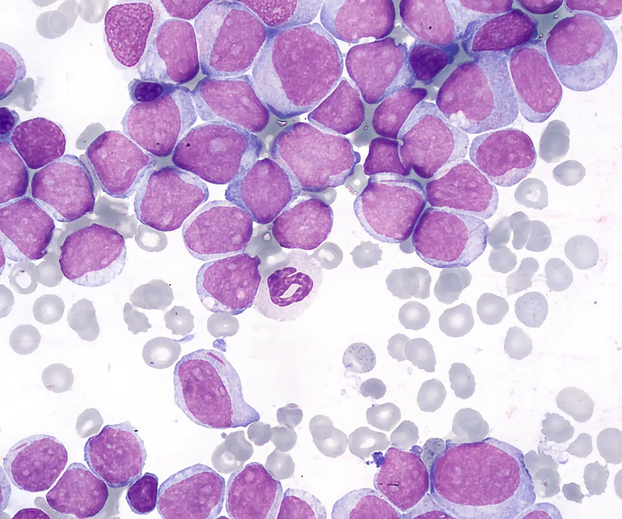 Acute Myelobastic Leukemia - Bone Marrow Smear