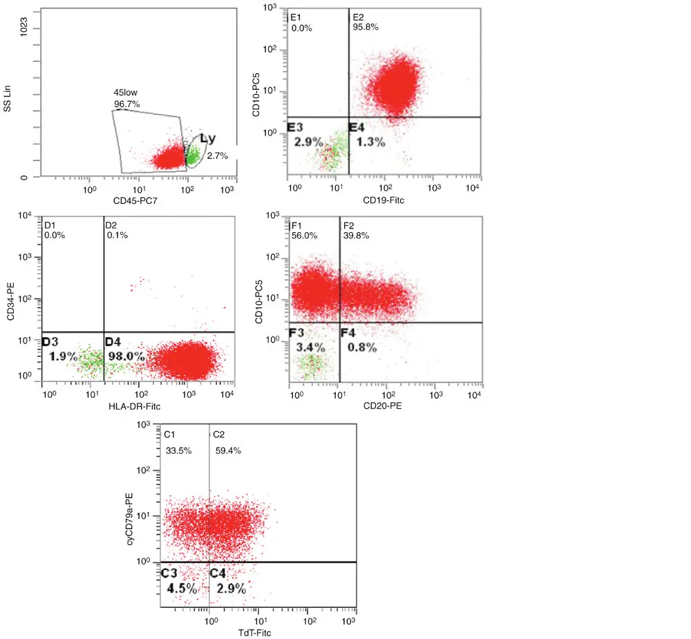 Flow cytometry in ALL