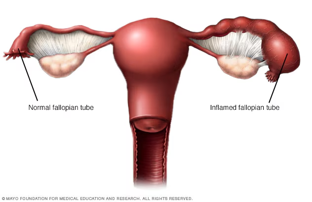 An Overview of Pelvic Inflammatory Disease (PID) in Kenya