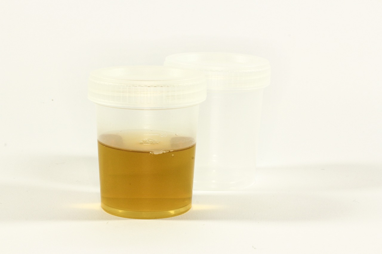 test, a container for urine, urine, inflammation, analysis, medical, lab, test tube, diagnostics, tests, the doctor, hospital, medic, download, urine, urine, urine, urine, urine